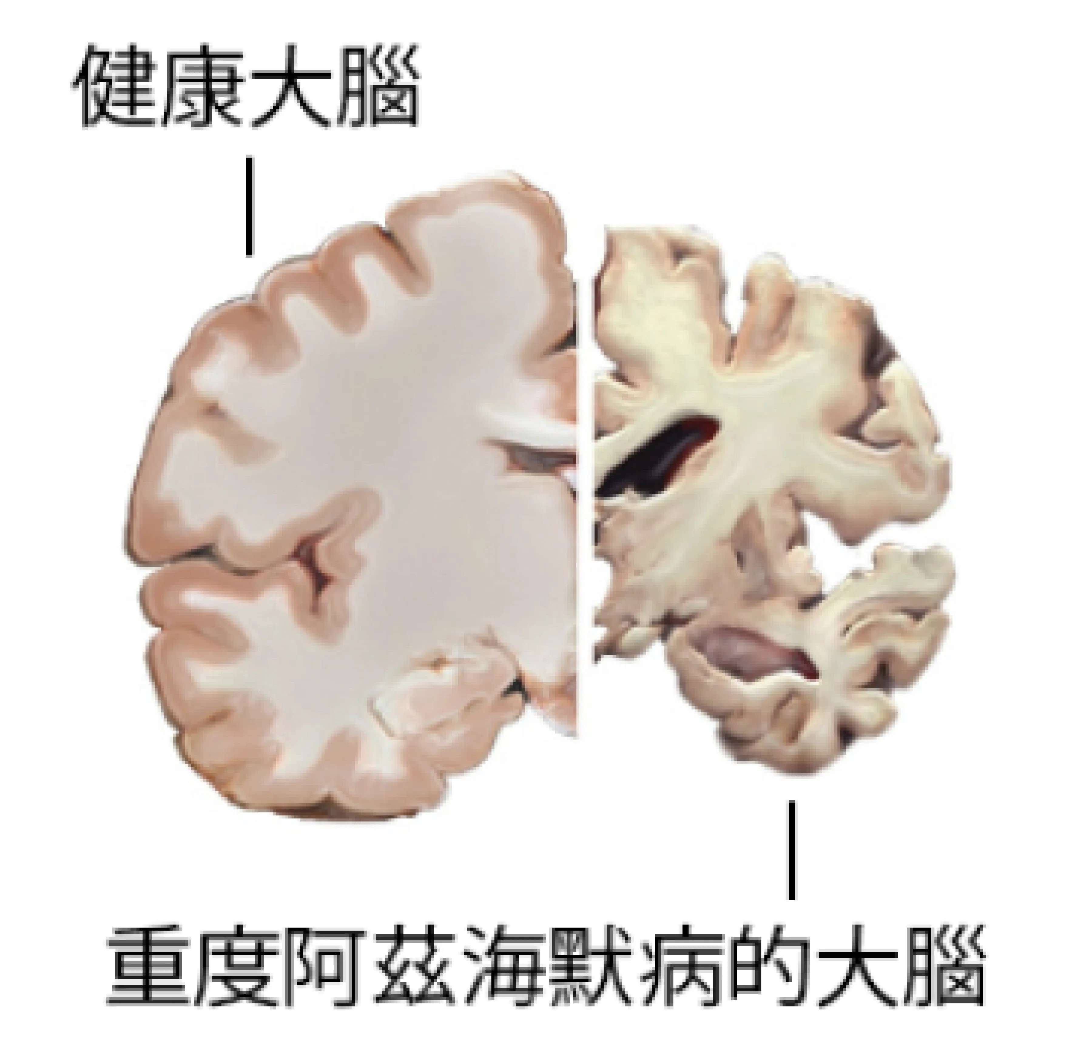 阿茲海默症大腦